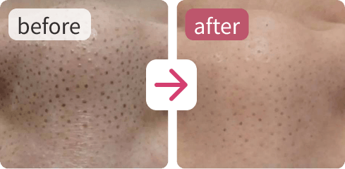 使用前と使用後の肌を並べた、ビフォーアフター比較写真