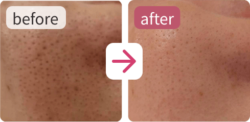 使用前と使用後の肌を並べた、ビフォーアフター比較写真