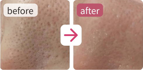 使用前と使用後の肌を並べた、ビフォーアフター比較写真