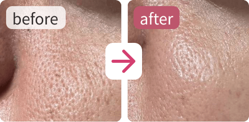 使用前と使用後の肌を並べた、ビフォーアフター比較写真